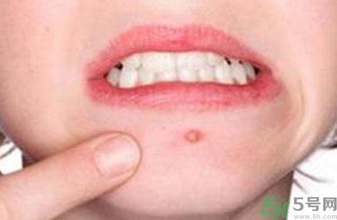 什么樣的痘痘能擠？哪些痘痘不能擠？