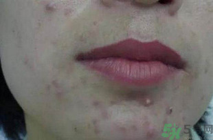 什么樣的痘痘能擠？哪些痘痘不能擠？