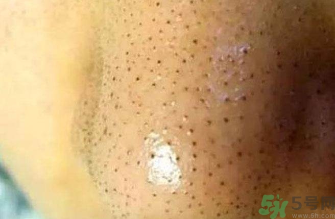 什么樣的痘痘能擠？哪些痘痘不能擠？