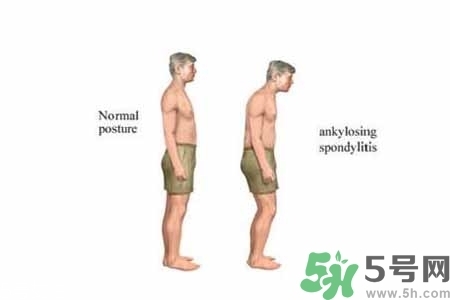 僵直性脊椎炎的癥狀有哪些？怎樣預(yù)防僵直性脊椎炎？