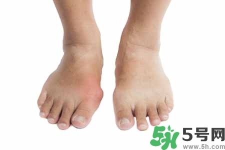 引發(fā)痛風(fēng)的原因是什么？痛風(fēng)病人飲食需注意什么好？