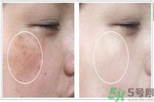 曬斑可以自己消退嗎？曬斑可以用激光去除嗎？
