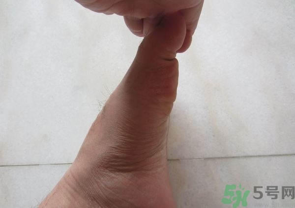 腳拇指外翻遺傳嗎？腳拇指外翻怎么矯正？