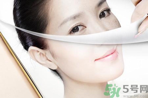 曬斑可以自己消退嗎？曬斑可以用激光去除嗎？