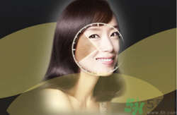 曬斑可以自己消退嗎？曬斑可以用激光去除嗎？