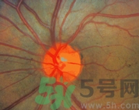 青光眼可以治愈嗎？青光眼怎樣治療？