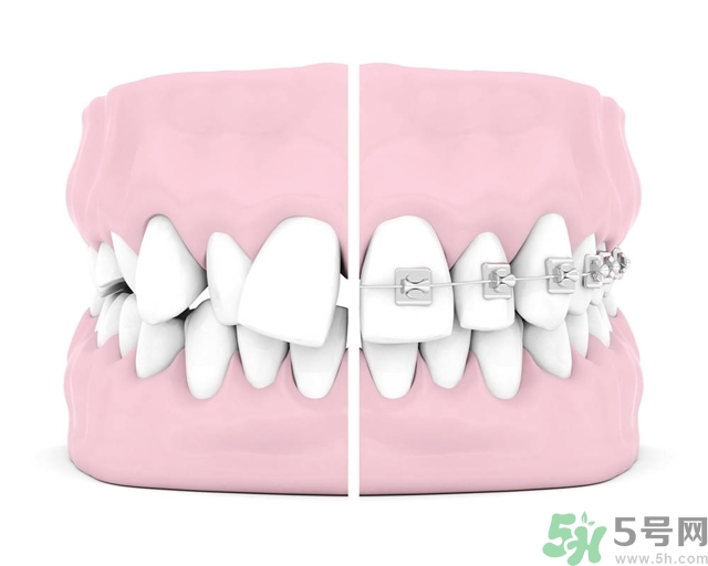 牙齒橫著長怎么辦？智齒橫著長一定要拔嗎？