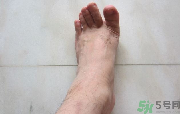 腳拇指外翻遺傳嗎？腳拇指外翻怎么矯正？