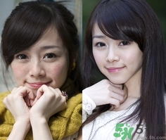 色斑會自己消失嗎？色斑遺傳嗎？