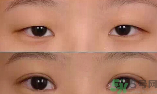 天生腫眼泡怎么消除？天生腫眼泡怎么辦？