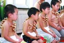 小孩可以拔罐嗎？寶寶能拔火罐嗎？
