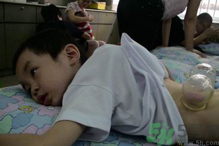 小孩可以拔罐嗎？寶寶能拔火罐嗎？