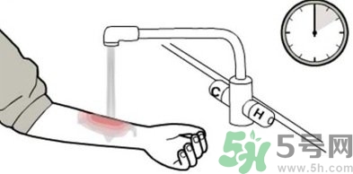 手被燙紅了怎么辦？手被燙了怎么止痛？