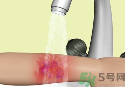 手被燙紅了怎么辦？手被燙了怎么止痛？