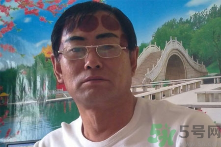 頭痛可以在額頭上拔火罐嗎？額頭上拔火罐有什么好處？