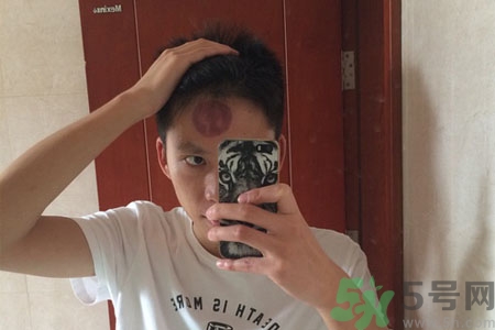 頭痛可以在額頭上拔火罐嗎？額頭上拔火罐有什么好處？