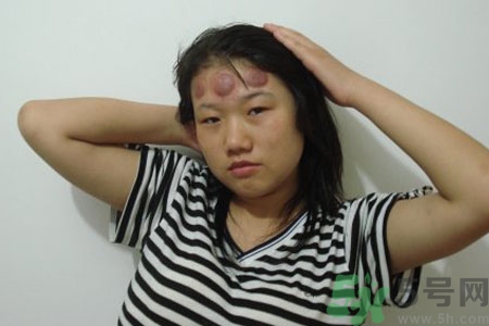 頭痛可以在額頭上拔火罐嗎？額頭上拔火罐有什么好處？