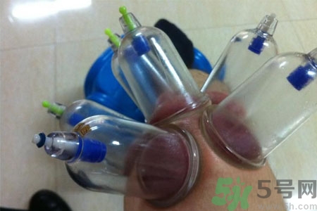 膝蓋能拔罐嗎？膝蓋疼可以拔罐嗎？