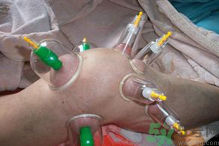 膝蓋能拔罐嗎？膝蓋疼可以拔罐嗎？