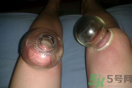 膝蓋能拔罐嗎？膝蓋疼可以拔罐嗎？