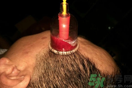 太陽(yáng)穴可以拔火罐嗎？偏頭疼可以在太陽(yáng)穴拔火罐嗎？