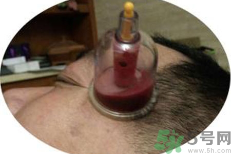 太陽(yáng)穴可以拔火罐嗎？偏頭疼可以在太陽(yáng)穴拔火罐嗎？