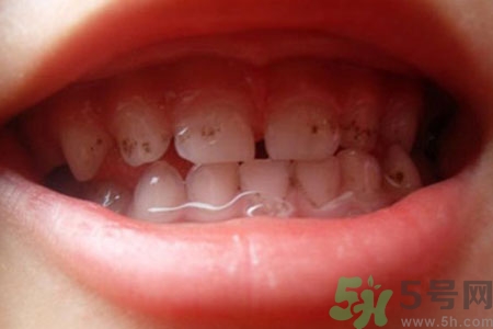小孩牙齒發(fā)黑怎么回事？小孩牙齒發(fā)黑怎么辦？