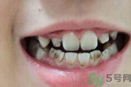 小孩牙齒發(fā)黑怎么回事？小孩牙齒發(fā)黑怎么辦？