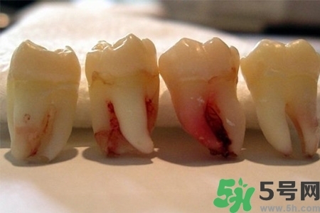 智齒長歪了一定要拔嗎？智齒長歪了必須拔嗎？