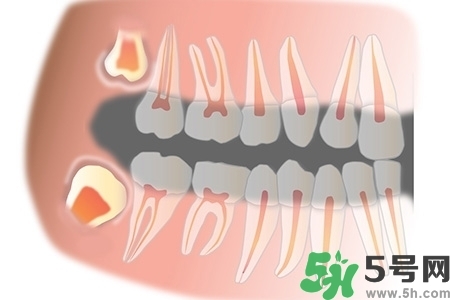 智齒長歪了一定要拔嗎？智齒長歪了必須拔嗎？