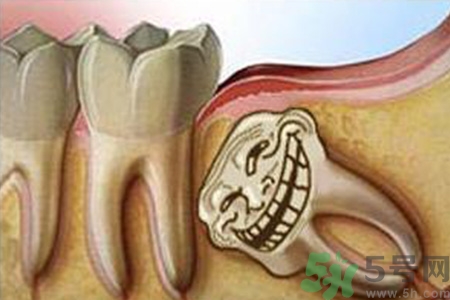 智齒長歪了一定要拔嗎？智齒長歪了必須拔嗎？