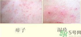 濕疹和痱子一樣嗎？濕疹和痱子有甚么區(qū)別？