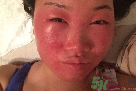 臉過敏發(fā)紅癢怎么辦？臉過敏發(fā)紅癢擦什么藥好？