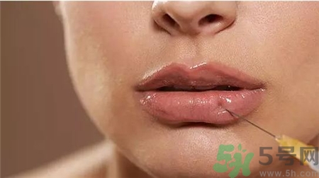 玻尿酸豐唇后多久消腫?玻尿酸豐唇后多久變軟? 玻尿酸豐唇后多久消腫?玻尿酸豐唇后多久變軟?