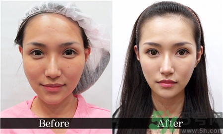 削骨瘦臉手術疼嗎?削骨瘦臉手術危險嗎? 削骨瘦臉手術疼嗎?削骨瘦臉手術危險嗎?