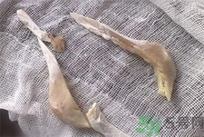 削骨瘦臉手術疼嗎?削骨瘦臉手術危險嗎? 削骨瘦臉手術疼嗎?削骨瘦臉手術危險嗎?