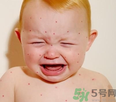 新生兒濕疹怎么引起的？新生兒濕疹如何處理？