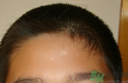 汗斑怎么治才能根除?汗斑用什么藥擦最有效 汗斑怎么治才能根除?汗斑用什么藥擦最有效