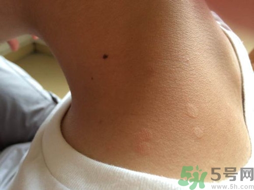 汗斑怎么治才能根除?汗斑用什么藥擦最有效 汗斑怎么治才能根除?汗斑用什么藥擦最有效