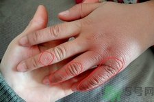 長凍瘡可以擦風油精嗎？風油精對凍瘡真的有效嗎？