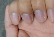 ?指甲上有豎紋是缺什么？指甲上有豎紋是缺維生素嗎？