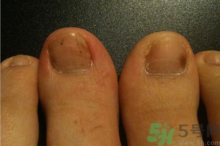 腳趾甲變黑是什么原因？腳趾甲變黑是怎么回事？