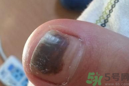 腳趾甲變黑是什么原因？腳趾甲變黑是怎么回事？