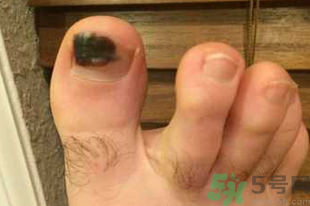 腳趾甲變黑是什么原因？腳趾甲變黑是怎么回事？