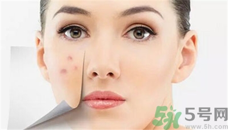 激光去痘印有效果嗎?激光祛痘會復(fù)發(fā)嗎?