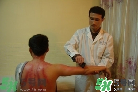 刮痧能治療風寒感冒嗎？刮痧治療風寒感冒效果好嗎