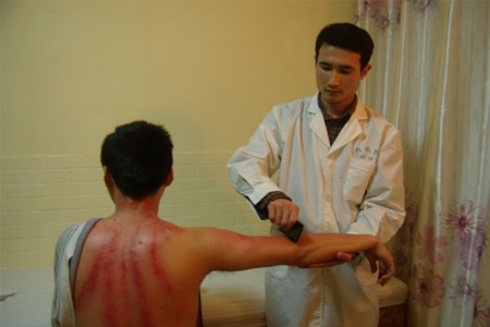 刮痧是什么原理？刮痧后需要注意什么？