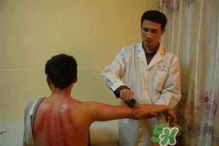 刮痧能去濕氣嗎？去濕氣是拔罐好還是刮痧好？