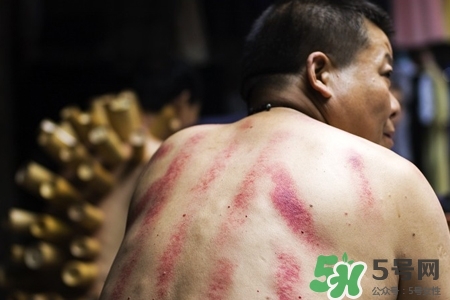 刮痧后什么顏色才健康？刮痧顏色反映的病癥