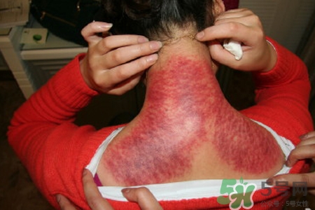 脖子刮痧的有什么作用？脖子刮痧的好處和壞處